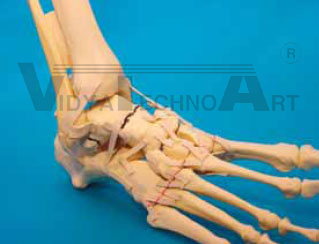 Foot single bones, fractured